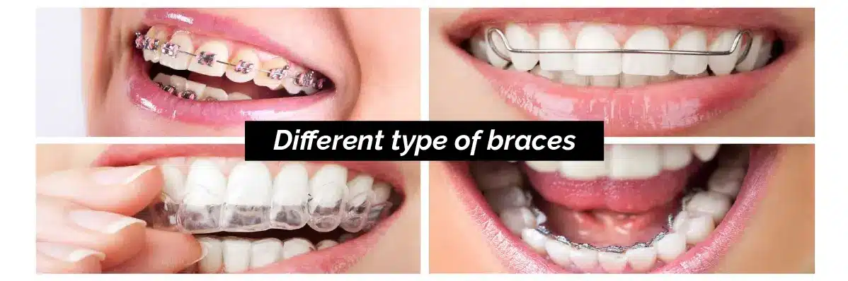 Different type of braces