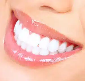 White teeth Treatment 
