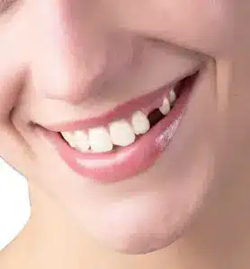 Loosening of the tooth Treatment 