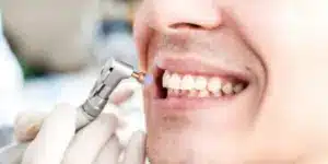 Dental cleaning Treatment 