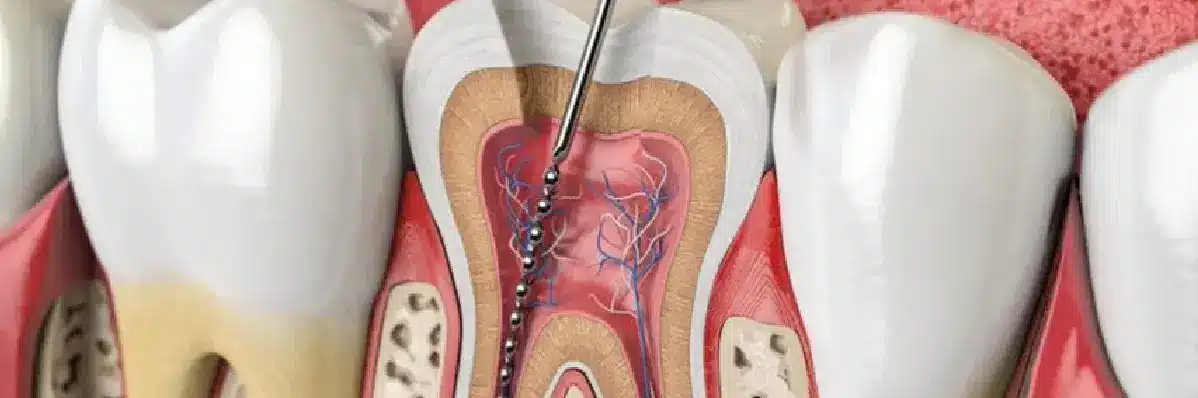 Causes of Pain After Root canal treatment