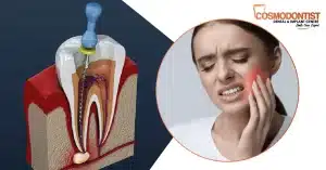 Pain after Root Canal Treatment