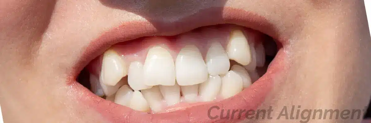 Alignment of Teeth