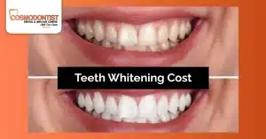 Teeth whitening cost in India