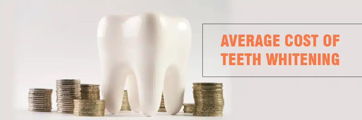 Teeth whitening Cost