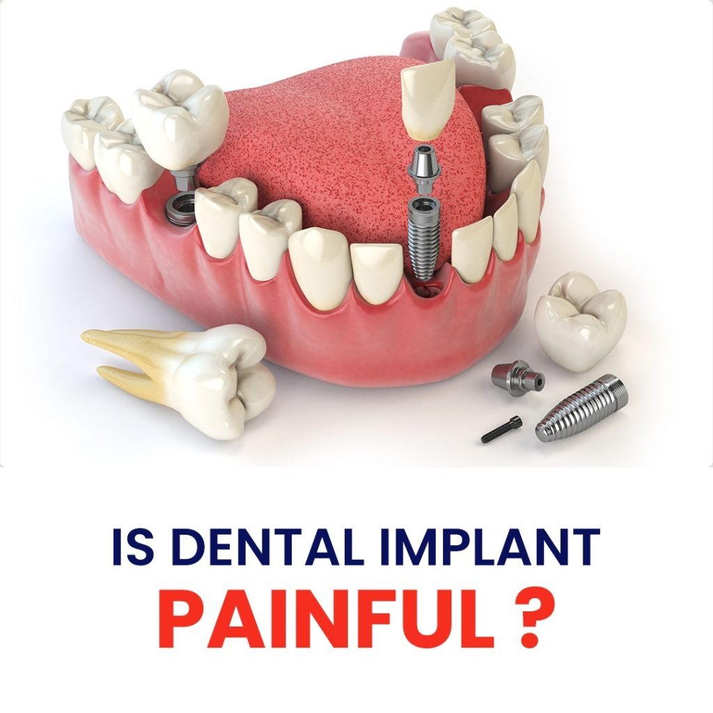 best dental implant clinic in India