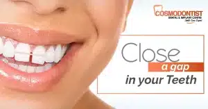 gap in your teeth