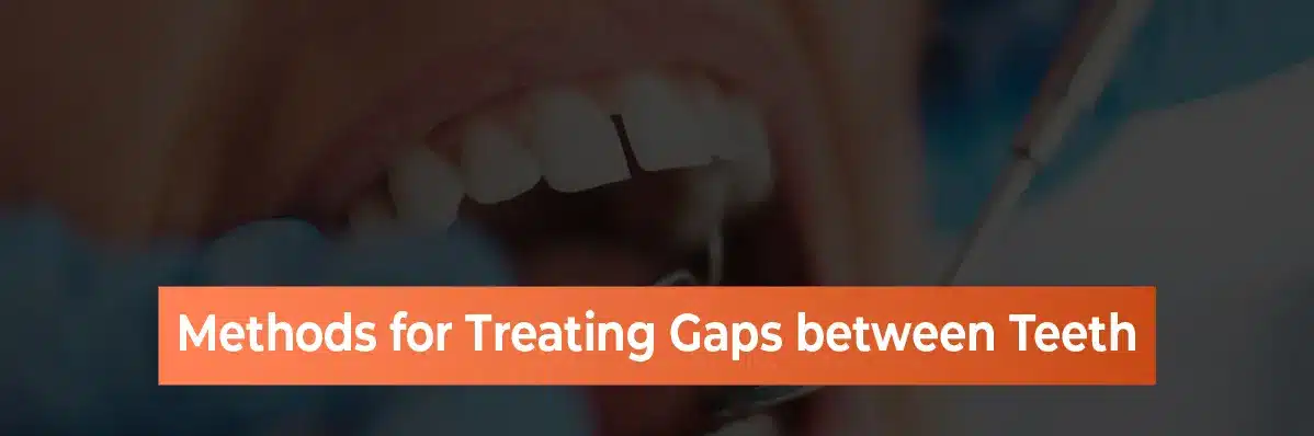 Methods for treating gaps between teeth