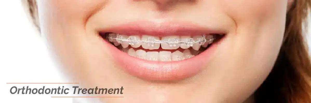 Orthodontic Treatment for Dental