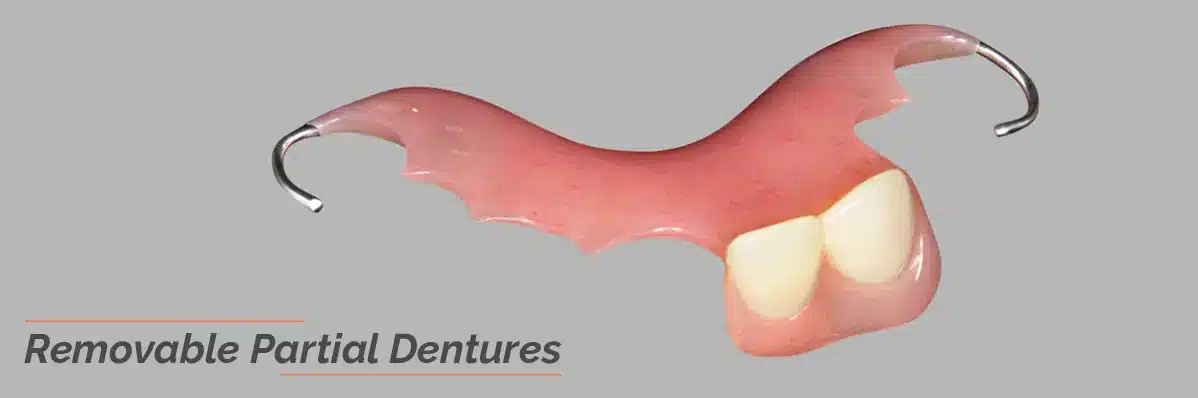 Removable partial dentures of Dental
