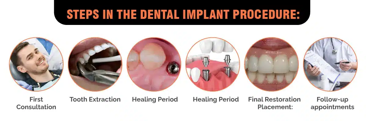Steps Of the dental implant procedures