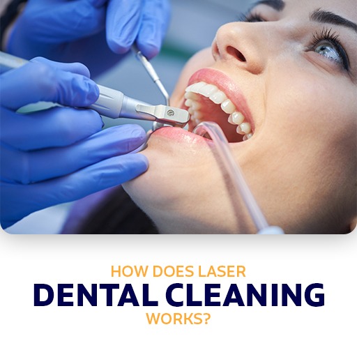 How does laser dental cleaning works?