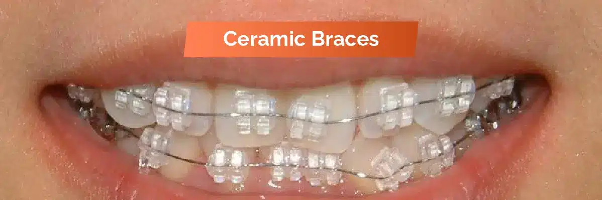 Ceramic Braces For Dental