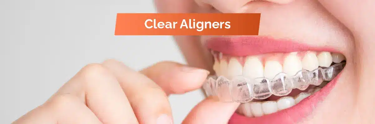 Clear Aligners For Dental