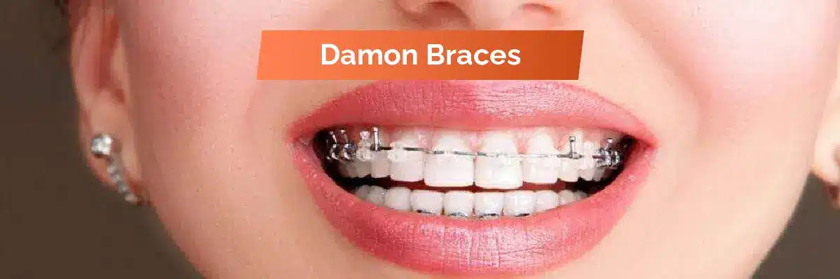 Damon Braces For Dental