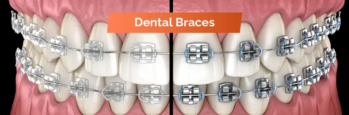 Best Braces For Dental