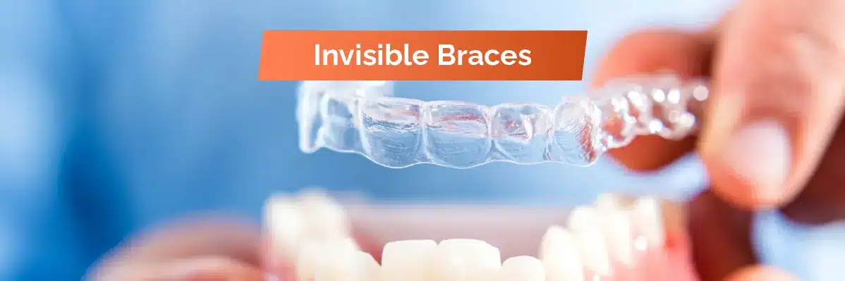 Invisible Braces For Dental
