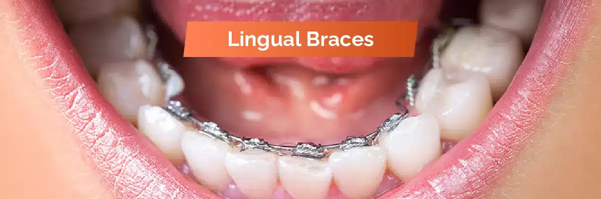 Lingual Braces For Dental