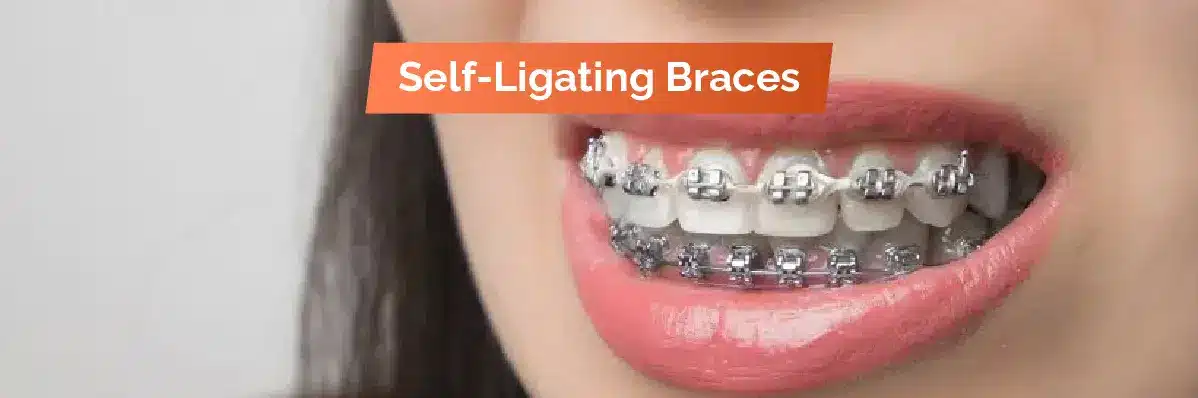 Self Ligating Braces for Dental