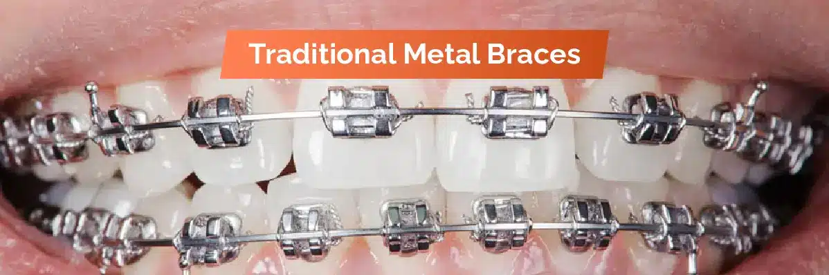 Traditional Metal Braces For Dental