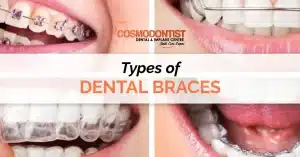 Different Types of Braces for Teeth