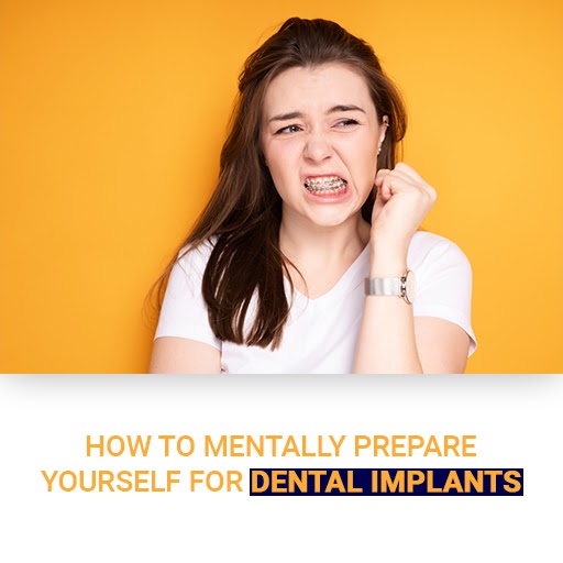 How To Mentally Prepare Yourself For Dental Implants