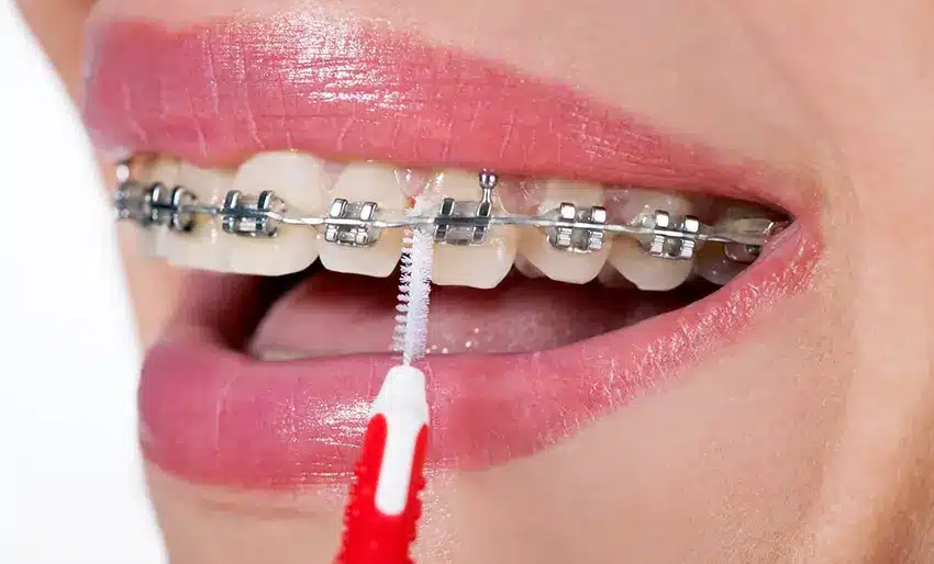 Routine Braces Care Dental Clinic in Gurgaon