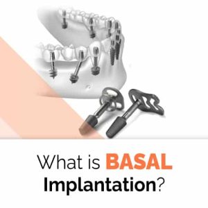 What is Basal Implantation?