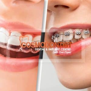 Different Types Of Braces And Their Costs