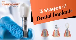 Here Are 3 Stages of Dental Implant Treatment