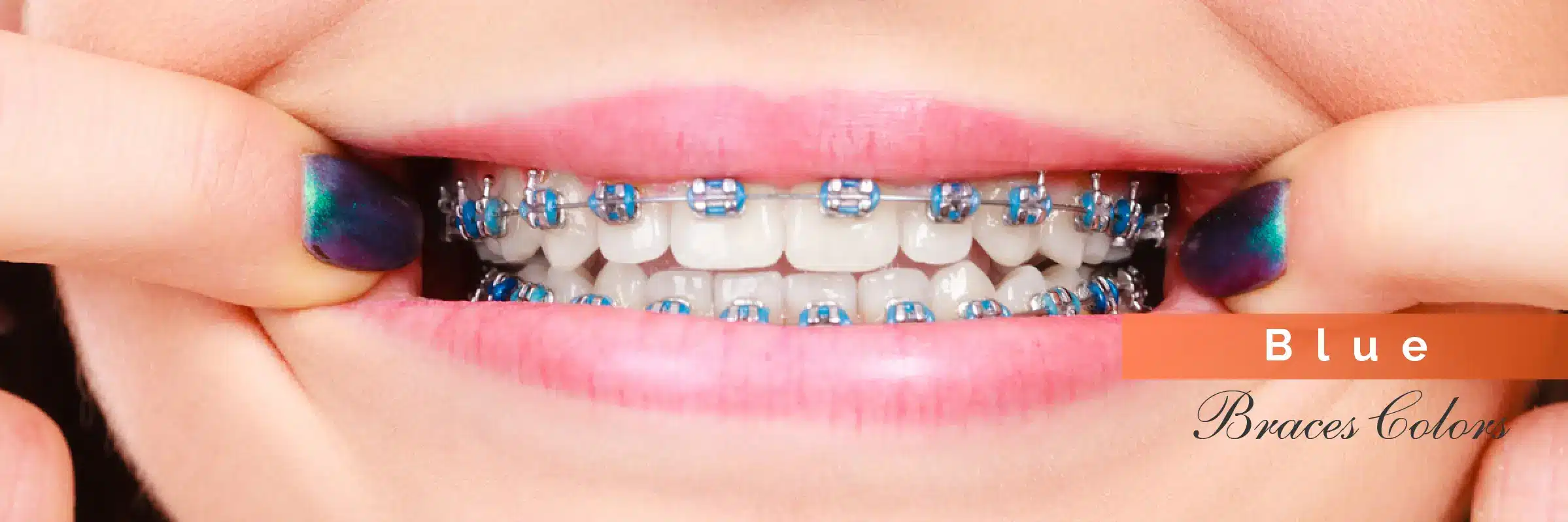 blue color braces