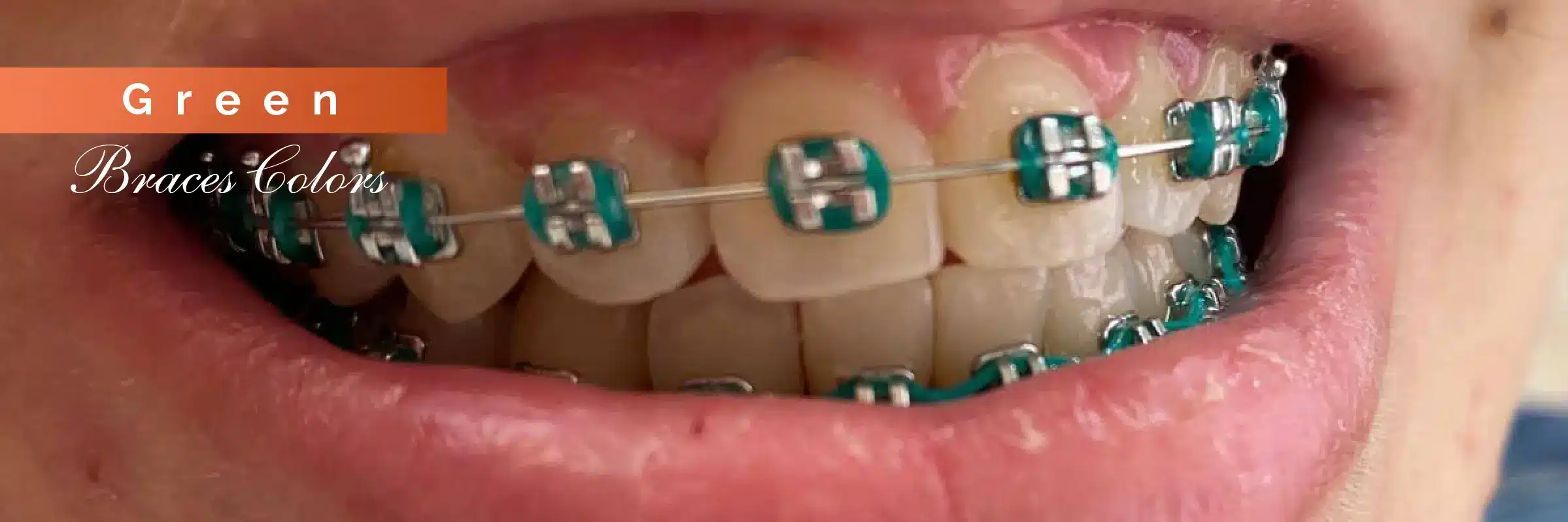 green color braces