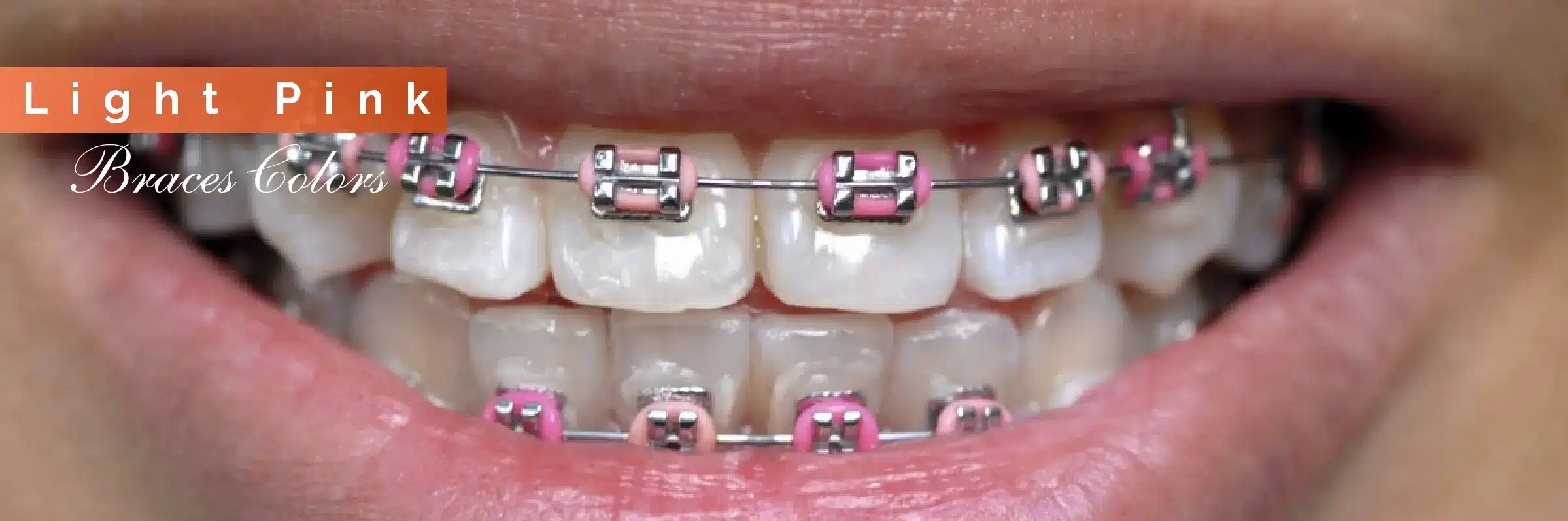 light pink color braces
