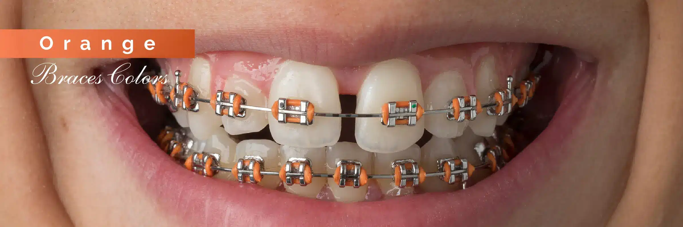 orange color braces