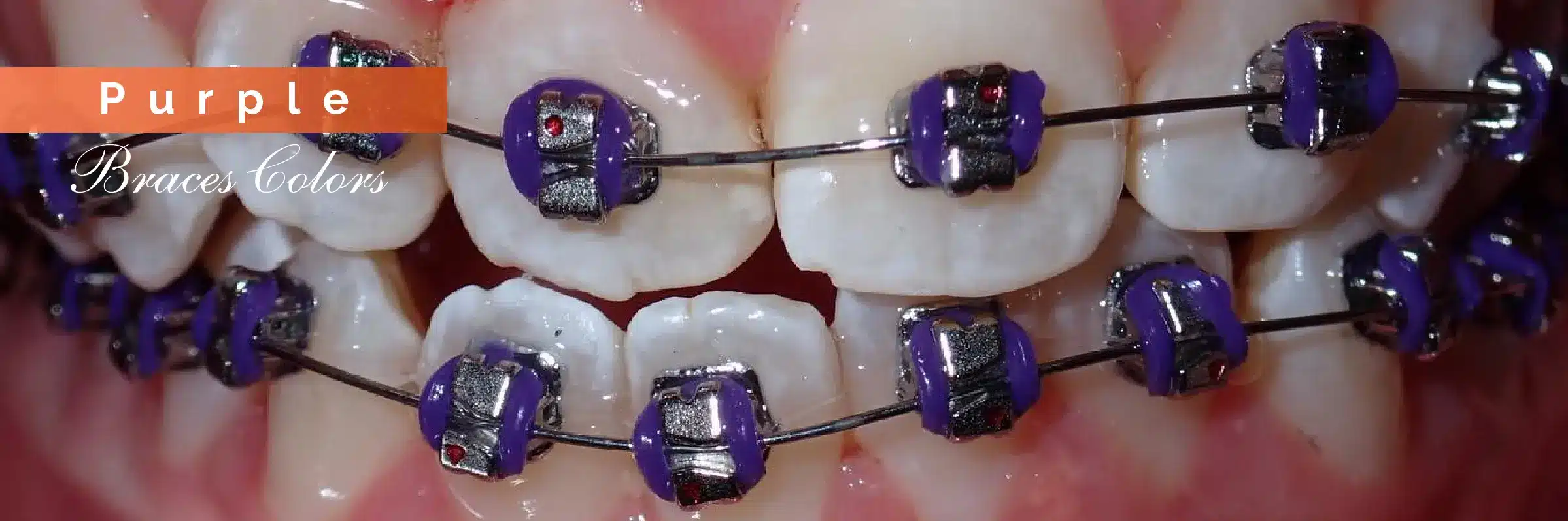 purple color braces