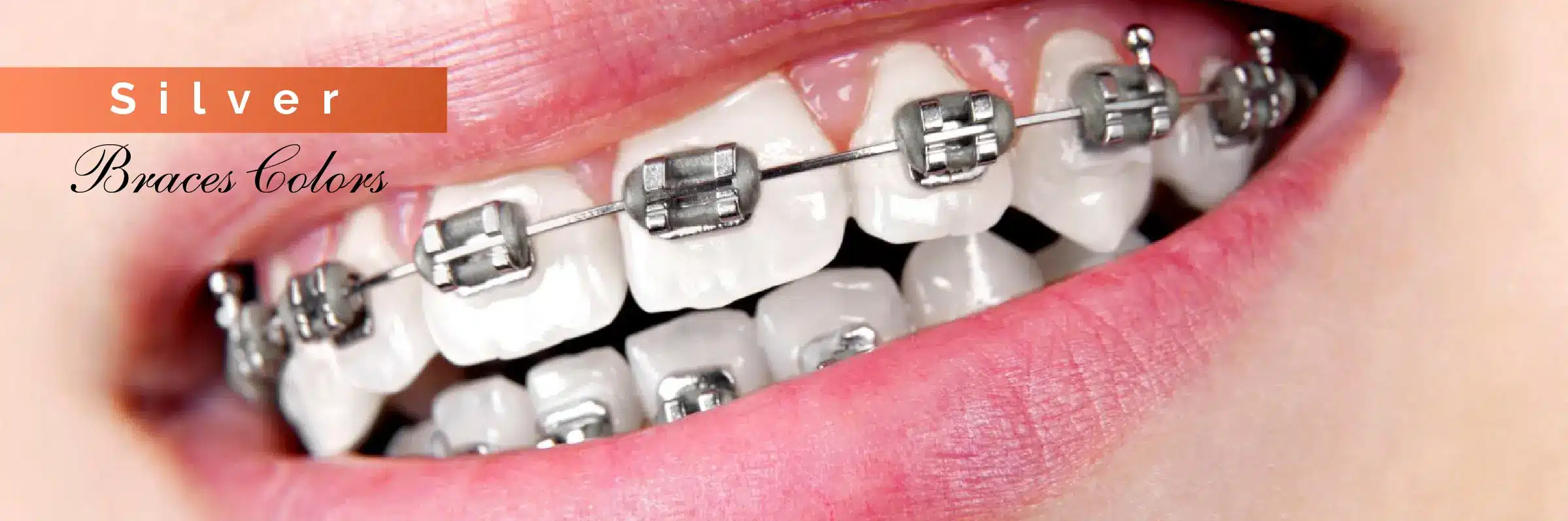 silver color braces