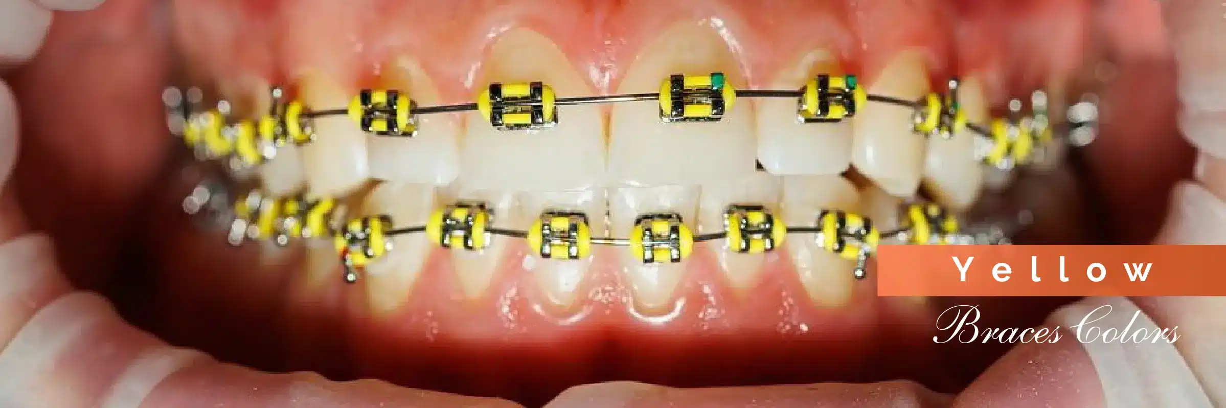 yellow color braces