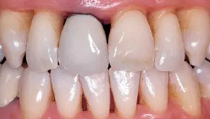 Advanced Periodontitis Gum Disease