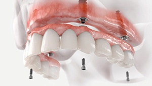 All-on-4 Dental Implants Gurgaon