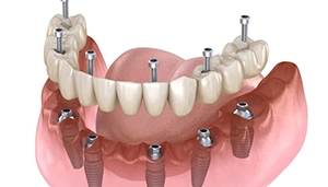 All-on-6 Dental Implants Gurgaon
