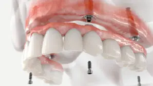 hybrid bridge on dental implant