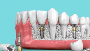Artificial tooth placement Dentures