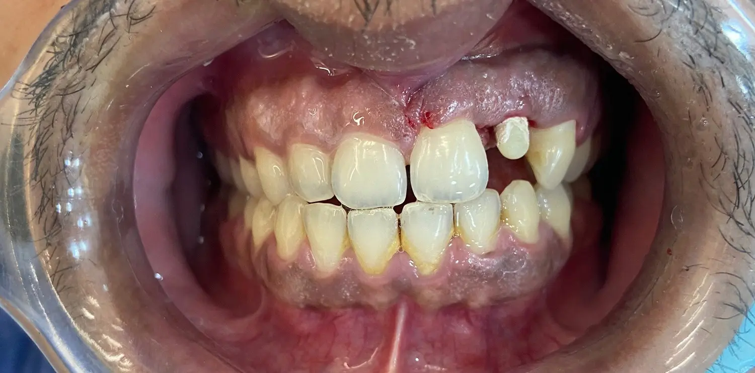 Single Teeth Dental Implant Results