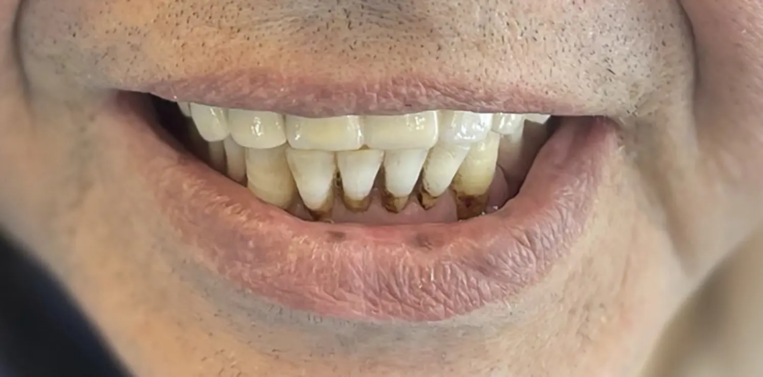 Dental Implant Treatment Results