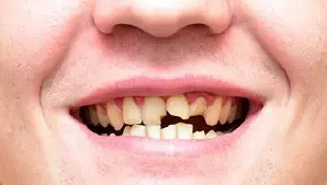 Broken or Chipped Teeth Image