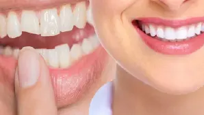 Dental Bonding Treatment Gurgaon
