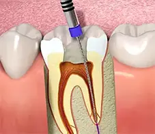 Root Canal treatment