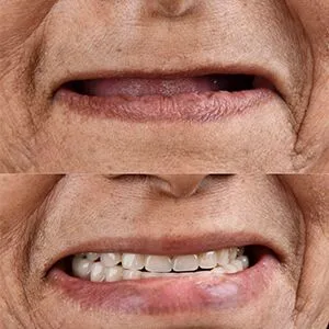 Dental implant treatment Image