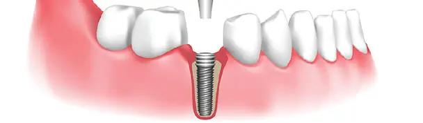 Implant placement Process