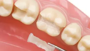Inlay Indirect Fillings